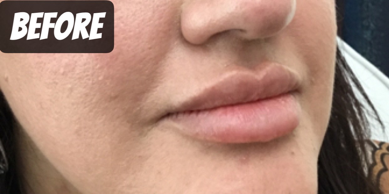 Before treatment