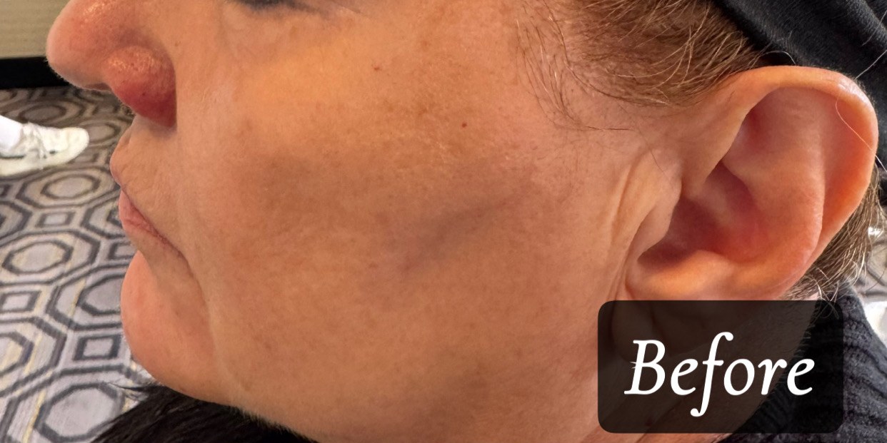 Before treatment