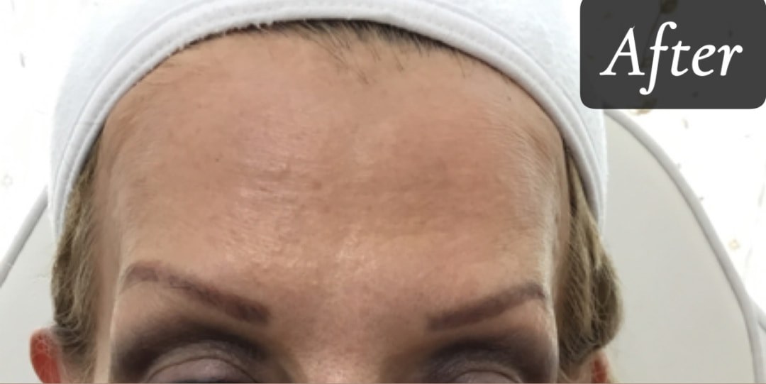 After treatment