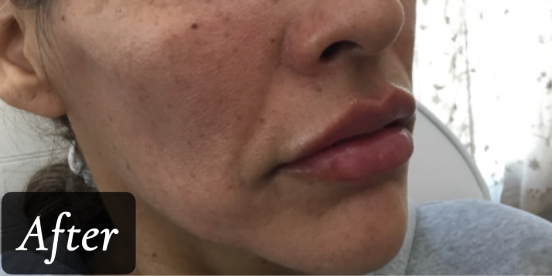 After treatment