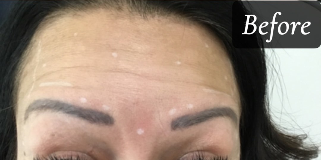 Before treatment