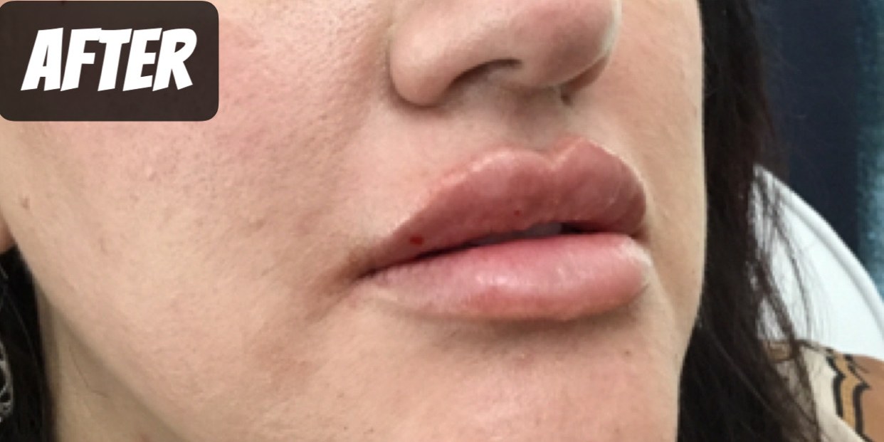 After treatment