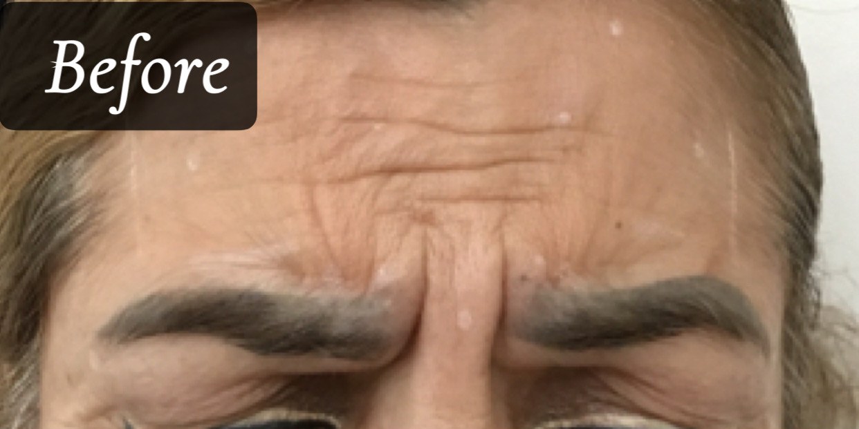 Before treatment
