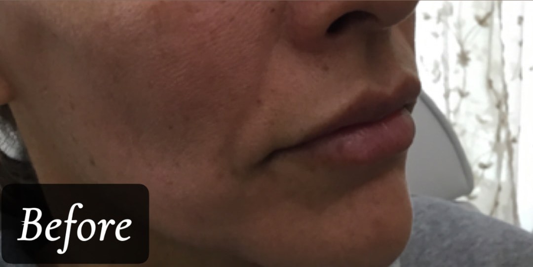 Before treatment