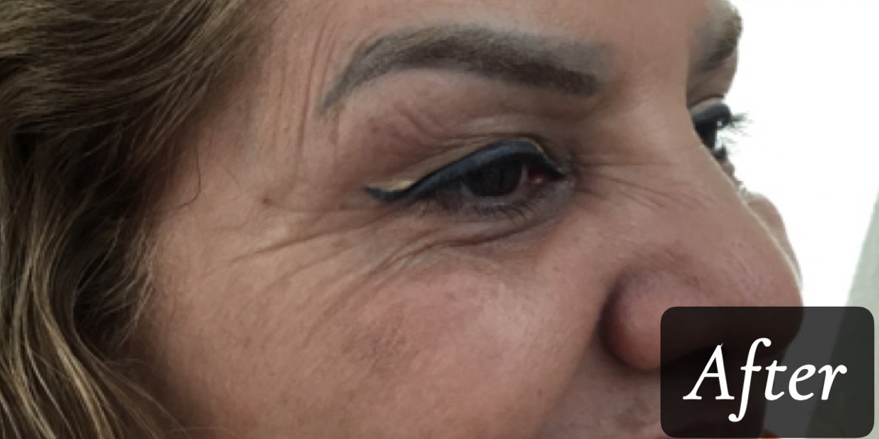 After treatment