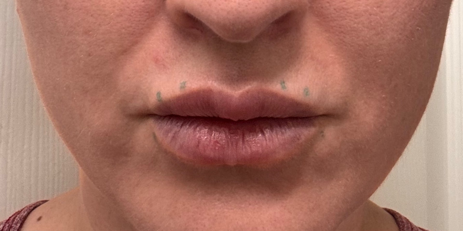 Before treatment