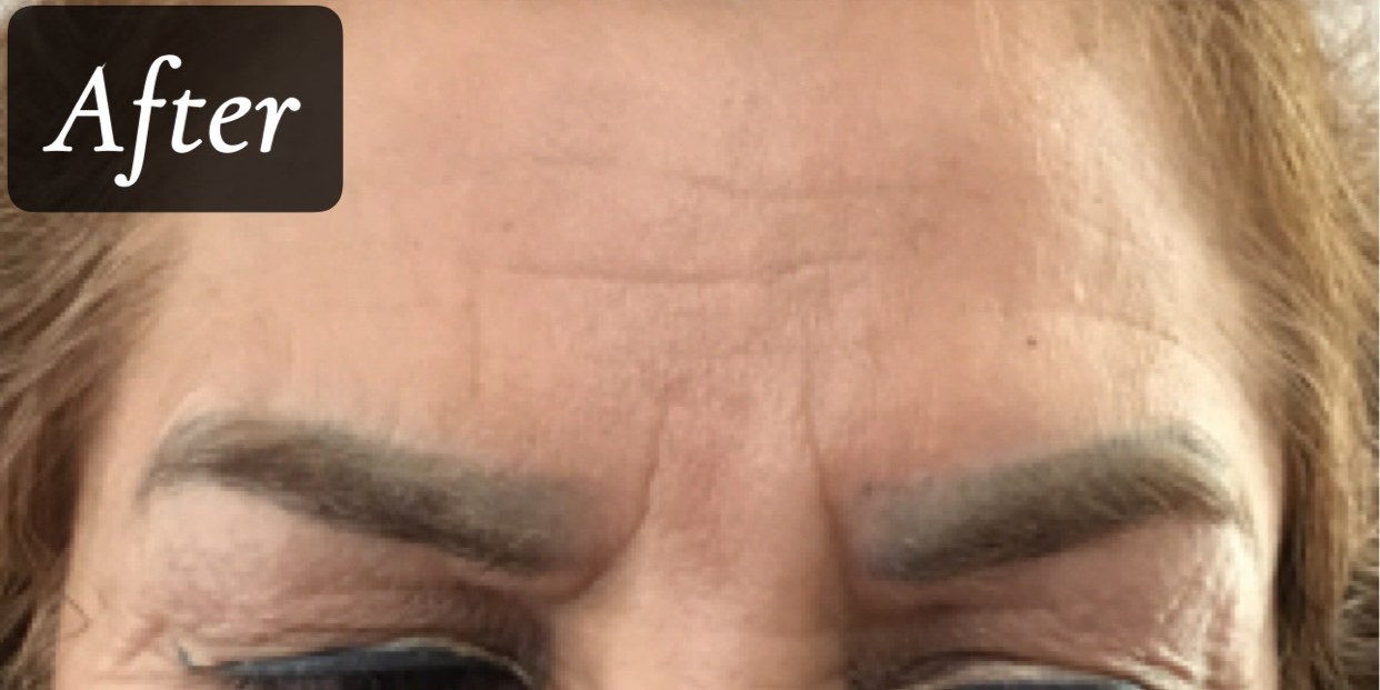 After treatment
