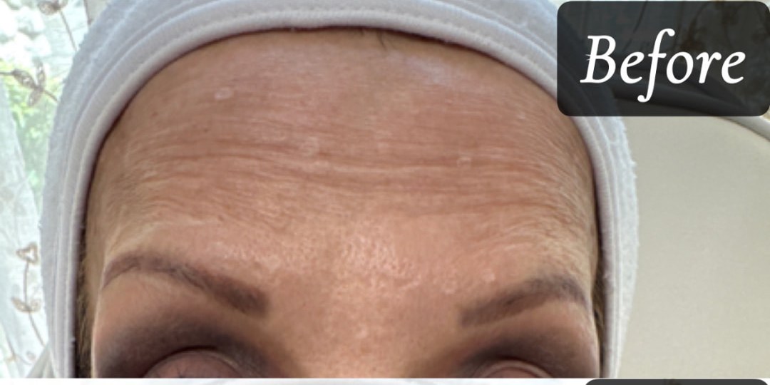 Before treatment